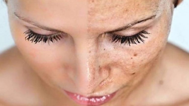 Cilt Lekeleri İçin Maske Tarifleri