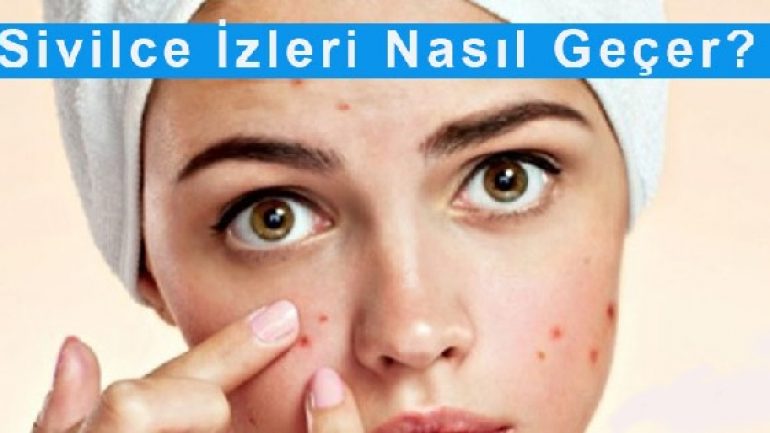 Sivilce İzleri Nasıl Geçer?